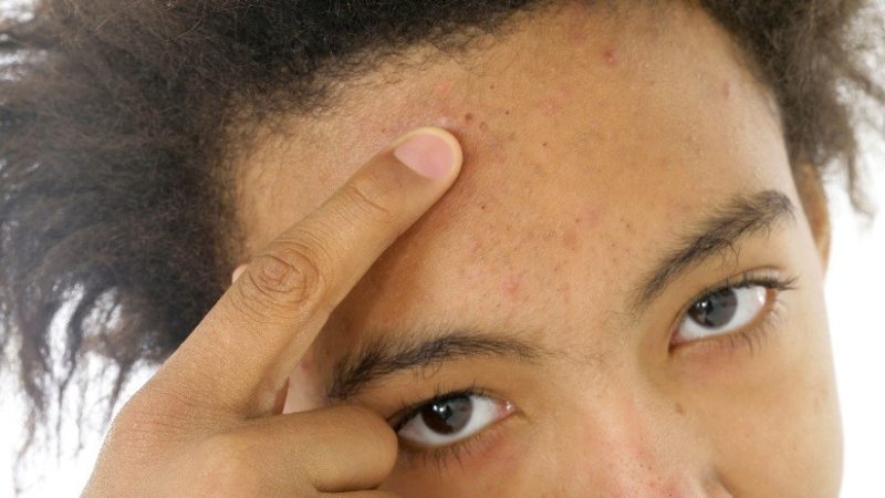 Desarrollan una ‘vacuna’ contra el acné en la Universidad de California San Diego