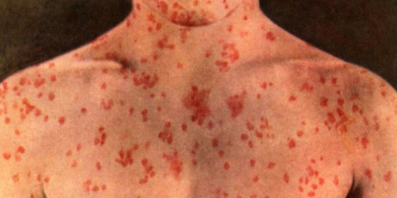 Ya han sido detectados 7 casos de sarampión en el condado de Los Angeles